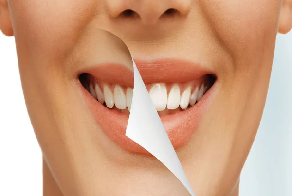 Teeth Whitening