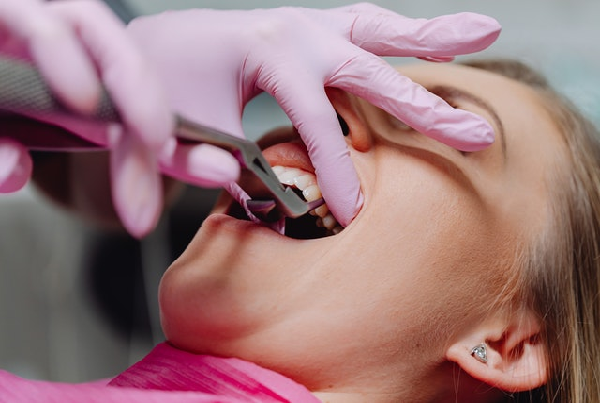 Impacted Tooth Surgery