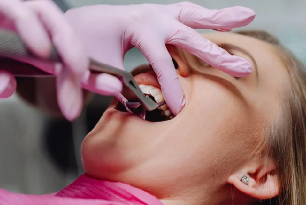 Impacted Tooth Surgery