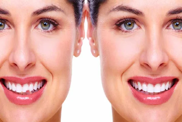 Teeth Reshaping